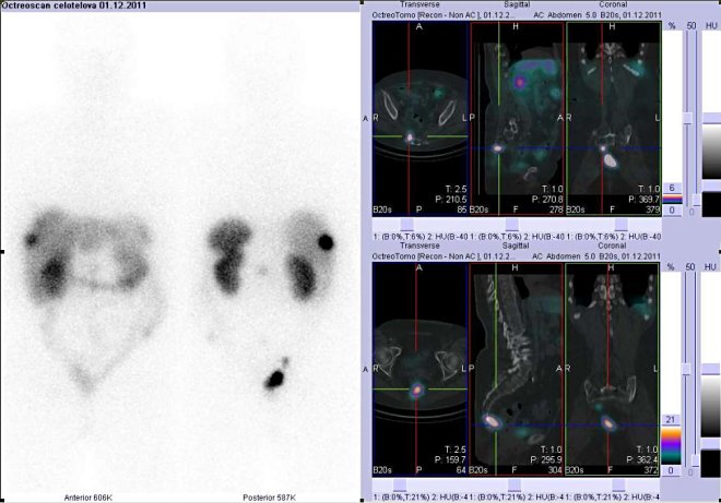 Obr. . 2: Celotlov scintigrafie v pedn a zadn projekci a fze obraz SPECT a CT. Vyeten 24 hod. po aplikaci radioindiktoru. Zameno na loisko presakrln vpravo-vpravo nahoe a na loisko v kosti kov-vpravo dole.