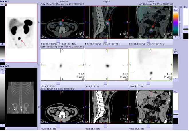 Obr. č. 4: SPECT, CT a fúze obrazů SPECT a CT. Vyšetření 4 hod. po aplikaci radioindikátoru. Nahoře fúze obrazů, uprostřed obrazy SPECT, dole obrazy CT, vždy vlevo transverzální  řezy, uprostřed sagitální řezy, vpravo řezy koronární. Zaměřeno na ložisko v břiše těsně vpravo od střední čáry ventrálně.