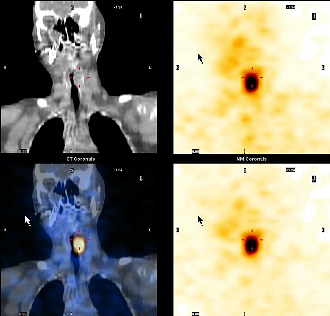 Obr. 2: SPECT, CT a SPECT/CT krku a mediastina, koronární řezy. Metastáza karcinomu štítné žlázy ve stěně laryngu.