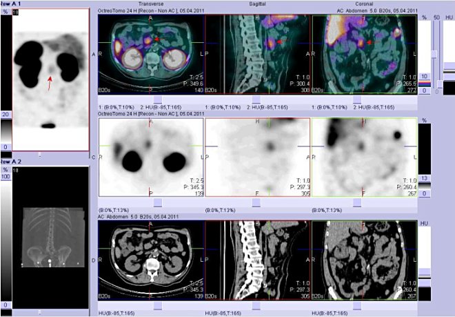 Obr. č. 4: Fúze obrazů SPECT a CT. Vyšetření 24 hod. po aplikaci radioindikátoru. Zaměřeno na ložisko na rozhraní epigastria a mesogastria těsně vpravo od střední čáry.