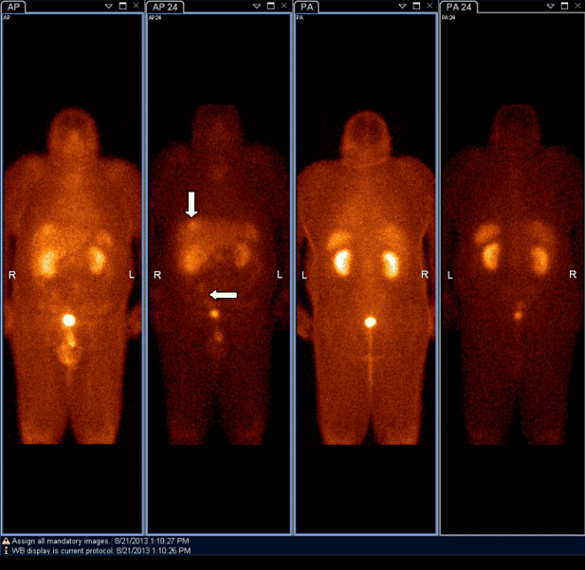 Obr.1: Scintigrafie pomocí 111In-OctreoScan metodou „whole body“ za 4 a  24 hodin po aplikaci radiofarmaka s  vícečetnými patologickými ložiskovými depozicemi radiofarmaka v oblasti jater a v pravém hypogastriu.