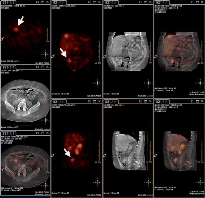 Obr.3: Scintigrafie pomocí 111In-OctreoScan metodou SPECT/CT s následnou rekonstrukcí v rovině transversální, sagitální a koronální za 24 hodin po aplikaci radiofarmaka s patologickou depozicí radiofarmaka v pravém hypogastriu.