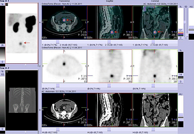 Obr. č. 3: Fúze obrazů SPECT a CT. Vyšetření 4 hod. po aplikaci radioindikátoru. Zaměřeno na ložisko v pánvi ve střední čáře.