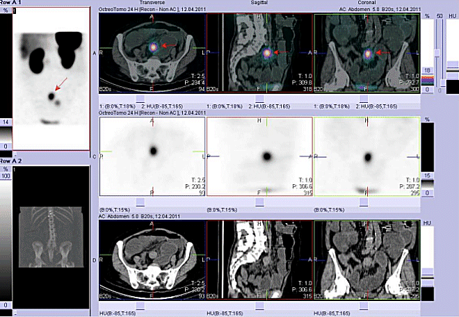 Obr.č.4: Fúze obrazů SPECT a CT. Vyšetření 24 hod. po aplikaci radioindikátoru. Zaměřeno na ložisko v pánvi ve střední čáře.