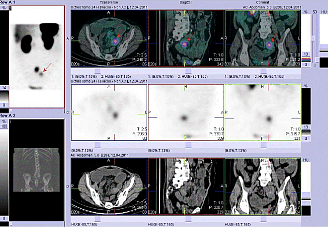 Obr. č. 5: Fúze obrazů SPECT a CT. Vyšetření 24 hod. po aplikaci radioindikátoru. Zaměřeno na ložisko v pánvi vlevo od střední čáry.