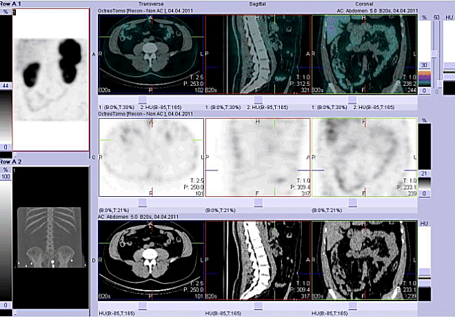 Obr. 3: Fúze obrazů SPECT a CT. Vyšetření 4 hod. po aplikaci radioindikátoru.