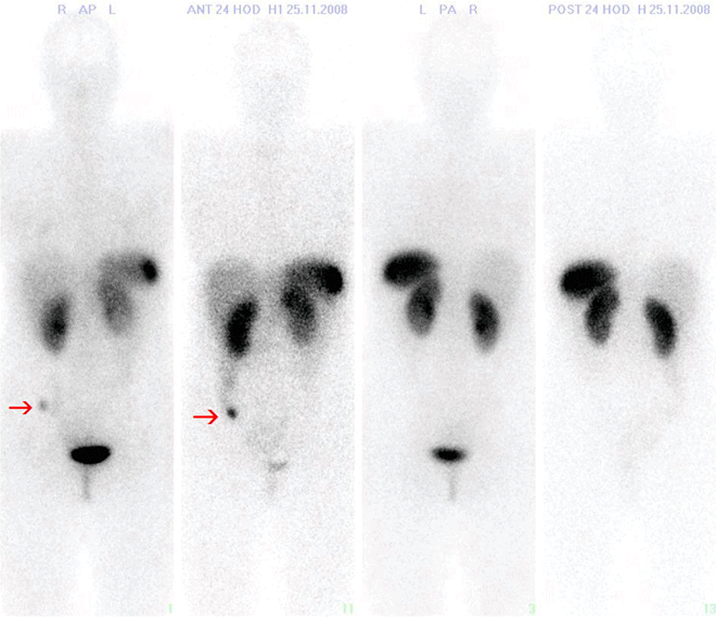 Obr. č. 2: Zkrácený WB-scan v přední i zadní projekci