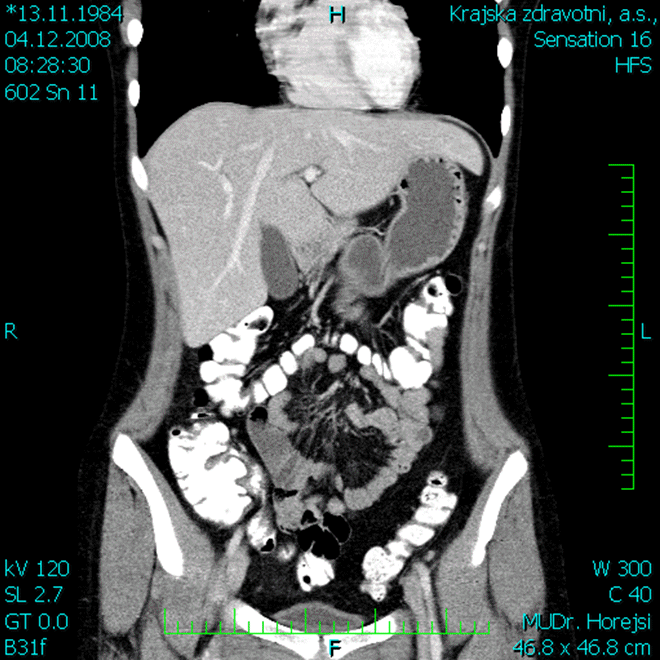 Obr. č. 3: CT břicha