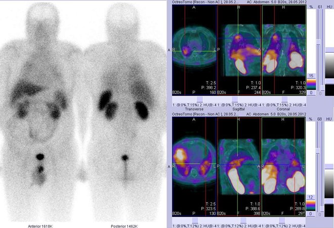 Obr. č. 1: Celotělová scintigrafie v přední a zadní projekci a fúze obrazů SPECT/CT. Vyšetření 4 hod. po aplikaci radioindikátoru. Vpravo nahoře zaměřeno na velké ložisko v horní části pravé plíce. Vpravo dole akumulace v srdci.