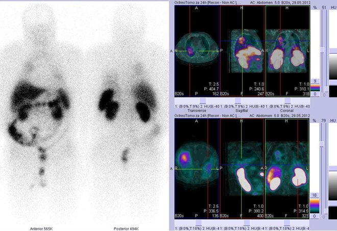 Obr. č. 5: Celotělová scintigrafie v přední a zadní projekci a fúze obrazů SPECT/CT. Vyšetření 24 hod. po aplikaci radioindikátoru. Vpravo nahoře zaměřeno na velké ložisko v horní části pravé plíce. Vpravo dole akumulace v srdci.