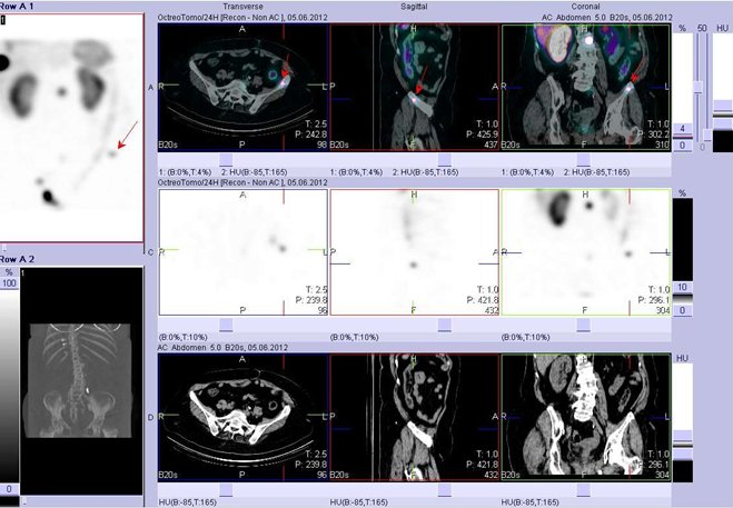 Obr. č. 11: Fúze obrazů SPECT a CT. Vyšetření 24 hod. po aplikaci radioindikátoru. Zaměřeno na ložisko v lopatě levé kosti kyčelní.