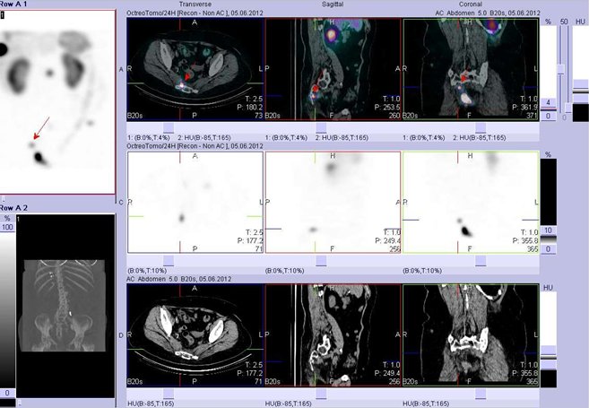 Obr. č. 12: Fúze obrazů SPECT a CT. Vyšetření 24 hod. po aplikaci radioindikátoru. Zaměřeno na presakrální ložisko.