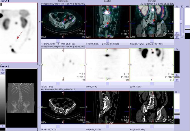 Obr. č. 13: Fúze obrazů SPECT a CT. Vyšetření 24 hod. po aplikaci radioindikátoru. Zaměřeno na ložisko presakrálně v úrovni obratle S1/S2.