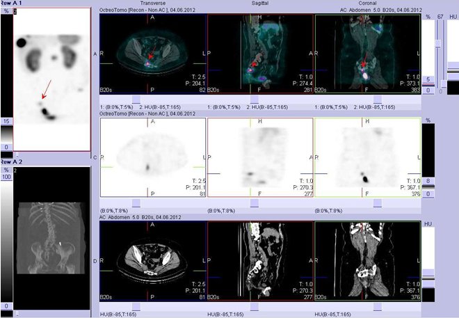 Obr. č. 5: Fúze obrazů SPECT a CT. Vyšetření 5 hod. po aplikaci radioindikátoru. Zaměřeno na presakrální ložisko.
