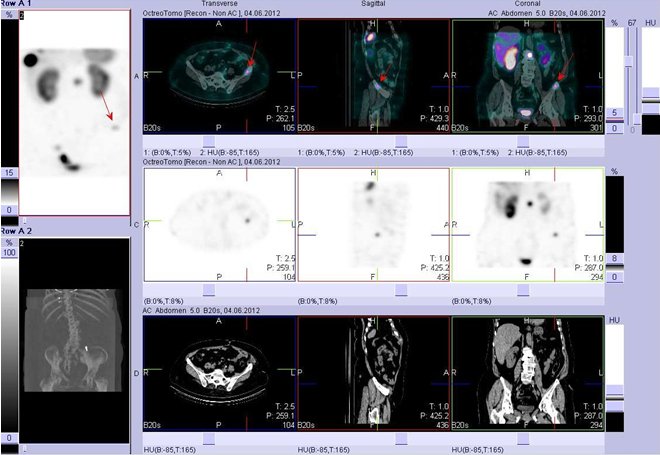 Obr. č. 6: Fúze obrazů SPECT a CT. Vyšetření 5 hod. po aplikaci radioindikátoru. Zaměřeno na ložisko v lopatě levé kosti kyčelní.