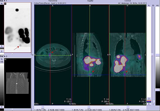 Obr.č.2: Fúze obrazů SPECT a CT – hrudník a proximální část břicha. Vyšetření 4 hod. po aplikaci radioindikátoru. Vlevo transverzální řez, uprostřed sagitální řez, vpravo koronální. Zaměřeno na ložisko v pravé části břicha.