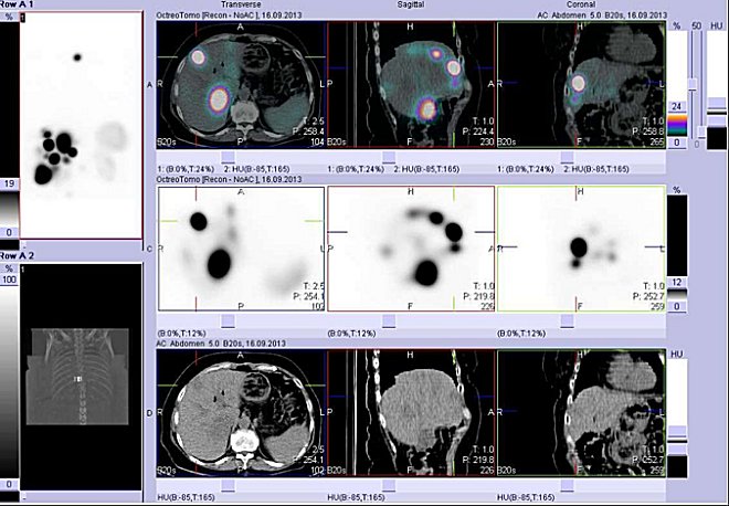 Obr.3: Fúze obrazů SPECT a CT – proximální část břicha. Vyšetření 4 hod. po aplikaci radiofarmaka. Nahoře fúze obrazů, uprostřed SPECT, dole CT. Vždy nad sebou: vlevo transverzální řezy, uprostřed sagitální řezy, vpravo koronální. Zaměřeno na ložisko ve ventrokraniální části pravého jaterního laloku.