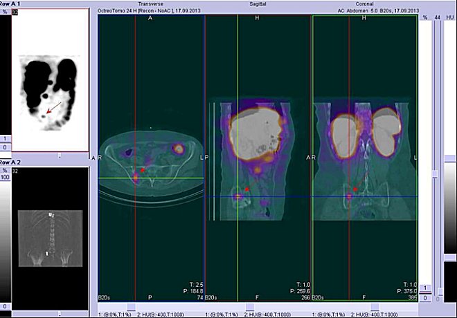 Obr. č. 5: Fúze obrazů SPECT a CT – břicho. Vyšetření 24 hod. po aplikaci radioindikátoru. Vlevo transverzální řez, uprostřed sagitální řez, vpravo koronální. Zaměřeno na ložisko v lopatě pravé kosti kyčelní.