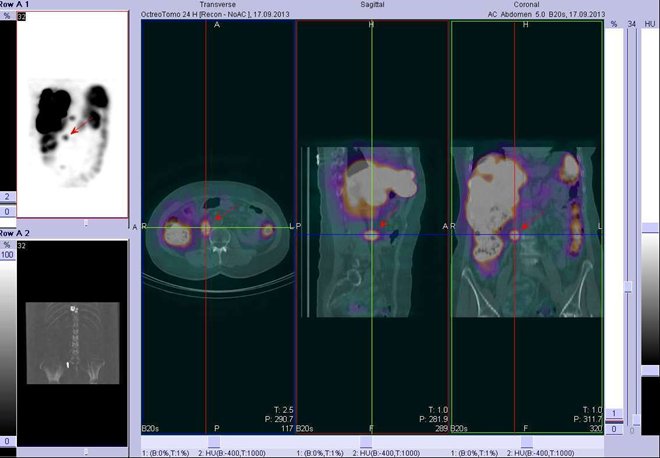 Obr. č. 6: Fúze obrazů SPECT a CT – břicho. Vyšetření 24 hod. po aplikaci radioindikátoru. Vlevo transverzální řez, uprostřed sagitální řez, vpravo koronální. Zaměřeno na ložisko v pravé části břicha.