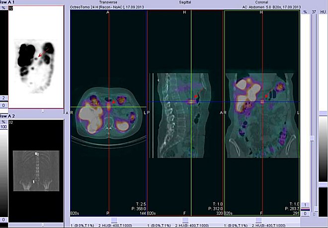 Obr. č. 7: Fúze obrazů SPECT a CT – břicho. Vyšetření 24 hod. po aplikaci radioindikátoru. Vlevo transverzální řez, uprostřed sagitální řez, vpravo koronální. Zaměřeno na ložisko v břiše ve střední čáře.