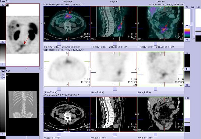 Obr. č. 4: Fúze obrazů SPECT a CT – vyšetření břicha. Vyšetření 4 hod. po aplikaci radiofarmaka. Nahoře fúze obrazů, uprostřed SPECT, dole CT. Vždy nad sebou: vlevo transverzální řezy, uprostřed sagitální řezy, vpravo koronární. Zaměřeno na ložisko v dolní části břicha ve střední čáře ventrálně.