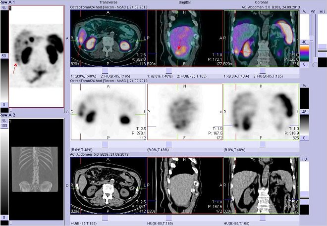 Obr. č. 7: Fúze obrazů SPECT a CT – vyšetření břicha. Vyšetření 24 hod. po aplikaci radiofarmaka. Nahoře fúze obrazů, uprostřed SPECT, dole CT. Vždy nad sebou: vlevo transverzální řezy, uprostřed sagitální řezy, vpravo koronární. Zaměřeno na ložisko v dolní části pravého jaterního laloku.