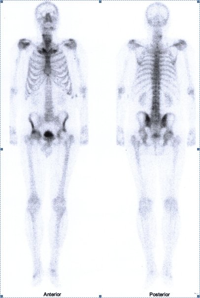 Obr.č.1: Celotělová scintigrafie skeletu v přední a zadní projekci.
