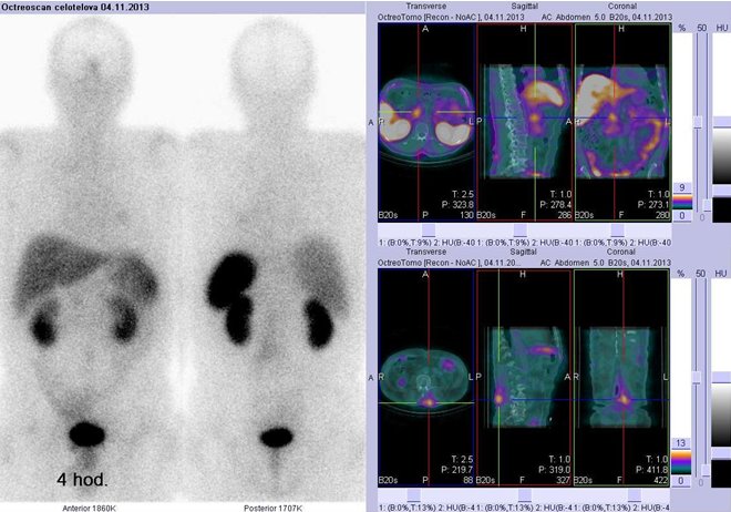 Obr. č. 2: Celotělová scintigrafie v přední a zadní projekci (vlevo) a fúze obrazů SPECT a CT (vpravo) – vyšetření břicha. Vpravo nahoře zaměřeno na aktivitu ve střevech, vpravo dole zaměřeno na aktivitu na zádech. Vpravo vždy nad sebou: vlevo transverzální řezy, uprostřed sagitální řezy, vpravo koronární. Vyšetření 4 hod. po aplikaci radioindikátoru.