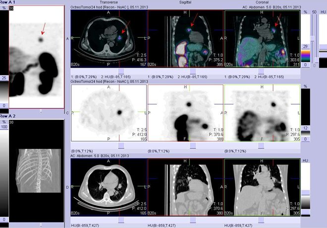 Obr.č.4: Fúze obrazů SPECT a CT – vyšetření hrudníku a části břicha. Vyšetření 24 hod. po aplikaci radiofarmaka. Nahoře fúze obrazů, uprostřed SPECT, dole CT. Vždy nad sebou: vlevo transverzální řezy, uprostřed sagitální řezy, vpravo koronární. Zaměřeno na ložisko v levém plicním hilu.