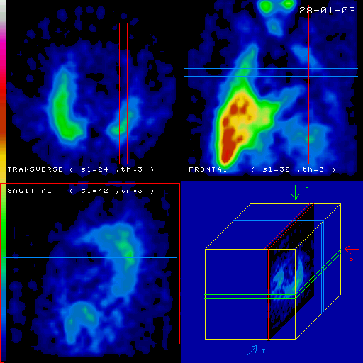 Obrázek č.2 - SPECT hrudníku pomocí MIBG I123, kontrolní scintigrafie po 6 měsících