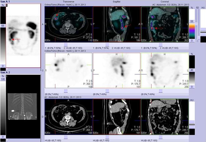 Obr.č.4: Celotělová scintigrafie v přední a zadní projekci a fúze obrazů SPECT a CT. Vyšetření 24 hod. po aplikaci radioindikátoru. Zaměřeno na aktivitu ve střevech – ve vzestupném tračníku.