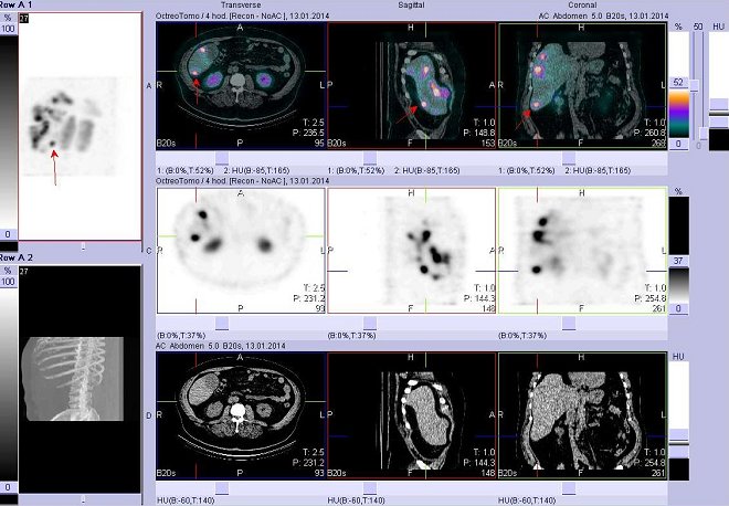 Obr. č. 3: Fúze obrazů SPECT a CT – vyšetření břicha. Vyšetření 5 hod. po aplikaci radiofarmaka. Nahoře fúze obrazů, uprostřed SPECT, dole CT. Vždy nad sebou: vlevo transverzální řezy, uprostřed sagitální řezy, vpravo koronární. Zaměřeno na ložisko v distální části  pravého jaterního laloku.