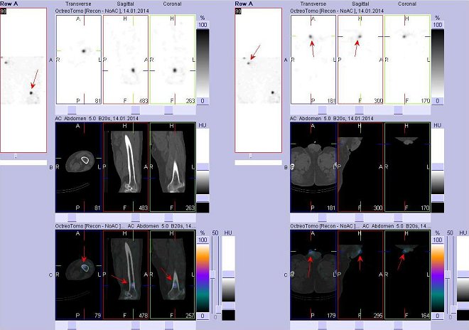 Obr. č. 5: FFúze obrazů SPECT a CT – vlevo levá stehenní kost, vpravo dolní části břicha. Vyšetření 24 hod. po aplikaci radiofarmaka. Nahoře SPECT, uprostřed CT, dole fúze obrazů. Vždy nad sebou: vlevo transverzální řezy, uprostřed sagitální řezy, vpravo koronární. Zaměřeno na ložisko v distální části  levé stehenní kosti, vpravo zaměřeno na ložisko aktivity podmíněné kontaminací.