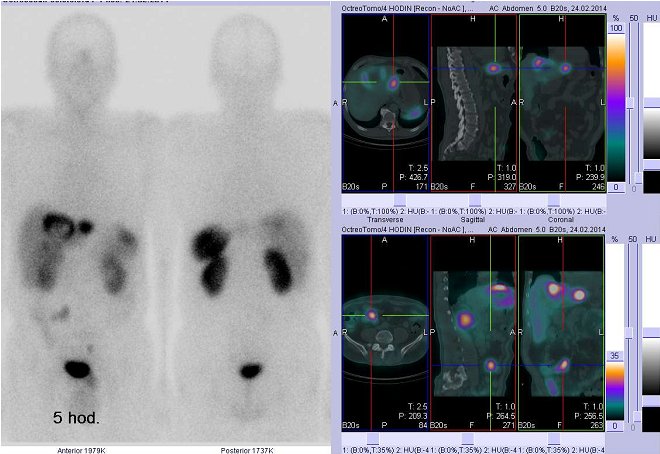 Obr.č.1: Celotělová scintigrafie v přední a zadní projekci a fúze obrazů SPECT a CT. Vyšetření 5 hod. po aplikaci radioindikátoru. Vpravo nahoře zaměřeno na  ložisko v levém jaterním laloku, vpravo dole zaměřeno na ložisko v pravém mesogastriu.