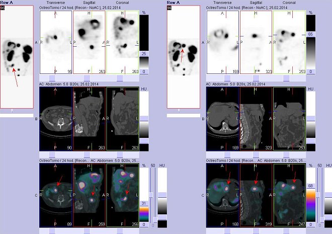 Obr. č. 3: Fúze obrazů SPECT a CT – vyšetření břicha. Vyšetření 24 hod. po aplikaci radiofarmaka. Vlevo nahoře SPECT, vlevo uprostřed CT, vlevo dole fúze obrazů, zaměřeno na ložisko v pravém mesogastriu. Vpravo nahoře SPECT, vpravo uprostřed CT, vpravo dole fúze obrazů, zaměřeno na ložisko v levém jaterním laloku.