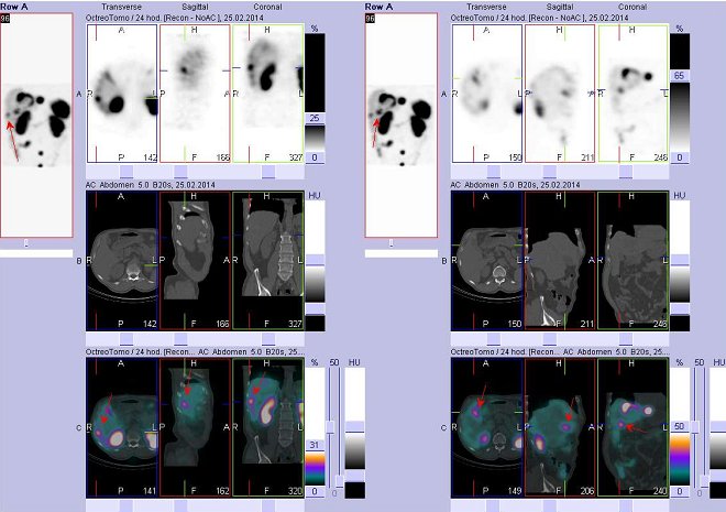 Obr.č.4: Fúze obrazů SPECT a CT – vyšetření břicha. Vyšetření 24 hod. po aplikaci radiofarmaka. Vlevo nahoře SPECT, vlevo uprostřed CT, vlevo dole fúze obrazů, zaměřeno na ložisko v pravém jaterním laloku. Vpravo nahoře SPECT, vpravo uprostřed CT, vpravo dole fúze obrazů, zaměřeno na ložisko v pravém jaterním laloku.