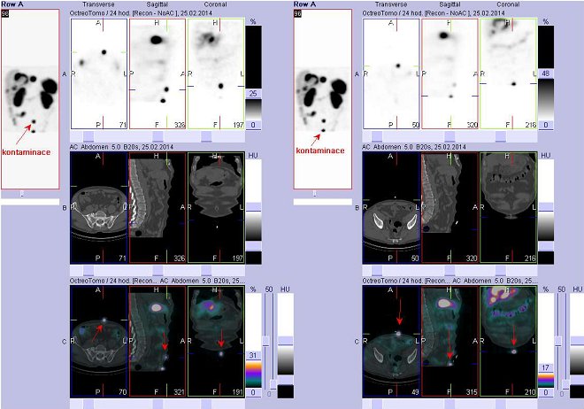Obr. č. 5: Fúze obrazů SPECT a CT – vyšetření břicha. Vyšetření 24 hod. po aplikaci radiofarmaka. Vlevo i vpravo nahoře SPECT,  uprostřed CT,  dole fúze obrazů, zaměřeno na dvě ložiska na povrchu těla v dolní části břicha ve střední čáře. Jedná se o kontaminaci.