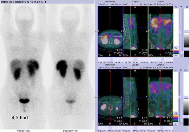 Obr.č.1: Celotělová scintigrafie v přední a zadní projekci a fúze obrazů SPECT a CT. Vyšetření 4,5 hod. po aplikaci radioindikátoru. Zaměřeno na ložisko v epigastriu vpravo od střední čáry.
