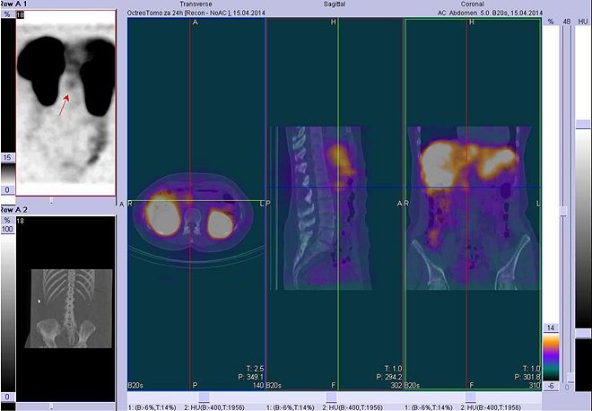 Obr. č. 3: Fúze obrazů SPECT a CT. Vyšetření 24 hod. po aplikaci radioindikátoru. Zaměřeno na ložisko v epigastriu vpravo od střední čáry.