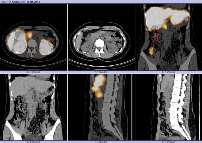 Obr.č.4: Fúze obrazů SPECT a CT a samostatné obrazy CT v řezech transverzálních, koronárních a sagitálních. Vyšetření 24 hod. po aplikaci radioindikátoru. Zaměřeno na ložisko v epigastriu vpravo od střední čáry.
