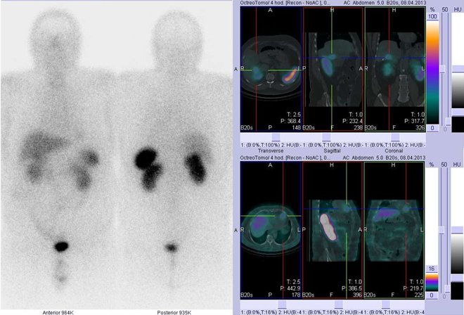 Obr. č. 1: Celotělová scintigrafie v přední a zadní projekci a fúze obrazů SPECT a CT. Vyšetření 4 hod. po aplikaci radioindikátoru. Vpravo nahoře: zaměřeno na ložisko v játrech, vpravo dole: zaměřeno na nevýrazné ložisko v srdci.