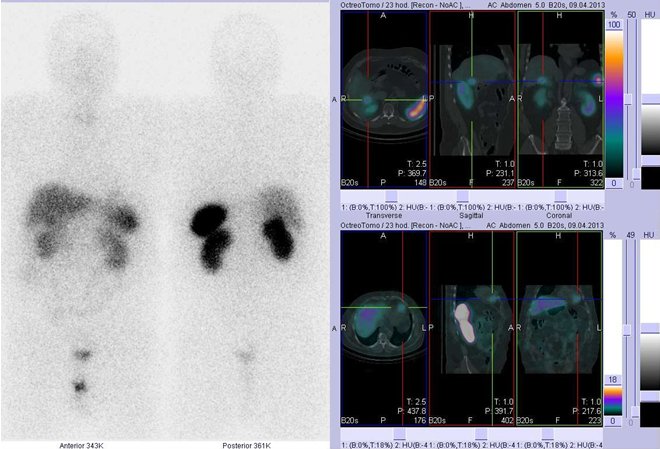 Obr. č. 2: Celotělová scintigrafie v přední a zadní projekci a fúze obrazů SPECT a CT. Vyšetření 23 hod. po aplikaci radioindikátoru. Vpravo nahoře: zaměřeno na ložisko v játrech, vpravo dole: zaměřeno na nevýrazné ložisko v srdci.