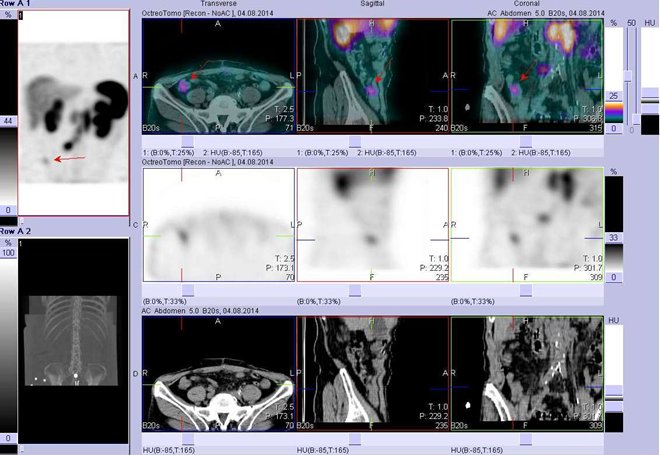 Obr. č. 2: Fúze obrazů SPECT a CT – vyšetření břicha. Vyšetření 4 hod. po aplikaci radiofarmaka. Nahoře fúze obrazů, uprostřed SPECT, dole CT. Vždy nad sebou: vlevo transverzální řezy, uprostřed sagitální řezy, vpravo koronární. Zaměřeno na ložisko v pravém hypogastriu.