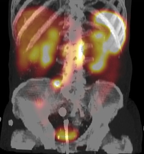 Obr. č. 5: Fúze obrazů SPECT a CT v 3D zobrazení břicha a pánve. Vyšetření 24 hod. po aplikaci radiofarmaka.