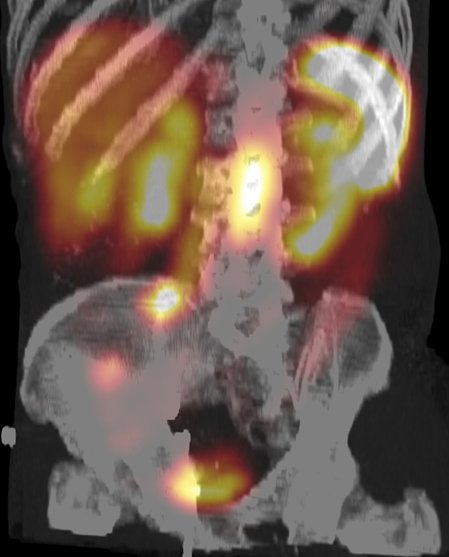 Obr. č. 6: Fúze obrazů SPECT a CT v 3D zobrazení břicha a pánve. Vyšetření 24 hod. po aplikaci radiofarmaka.