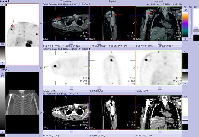 Obr.3: Fúze obrazů SPECT a CT – hrudník, paže. Vyšetření 4 hod. po aplikaci radiofarmaka. Nahoře fúze obrazů, uprostřed SPECT, dole CT. Vždy nad sebou: vlevo transverzální řezy, uprostřed sagitální řezy, vpravo koronární. Zaměřeno na ložisko v proximální části pravé pažní kosti.