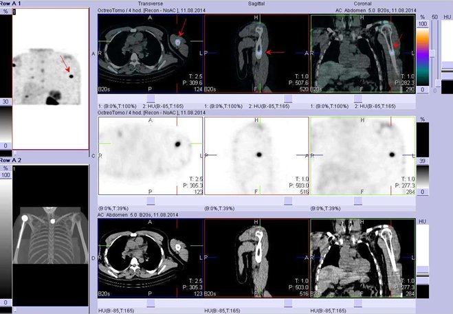 Obr. č. 4: Fúze obrazů SPECT a CT – hrudník, paže. Vyšetření 4 hod. po aplikaci radiofarmaka. Nahoře fúze obrazů, uprostřed SPECT, dole CT. Vždy nad sebou: vlevo transverzální řezy, uprostřed sagitální řezy, vpravo koronární. Zaměřeno na ložisko v diafýze levé pažní kosti.