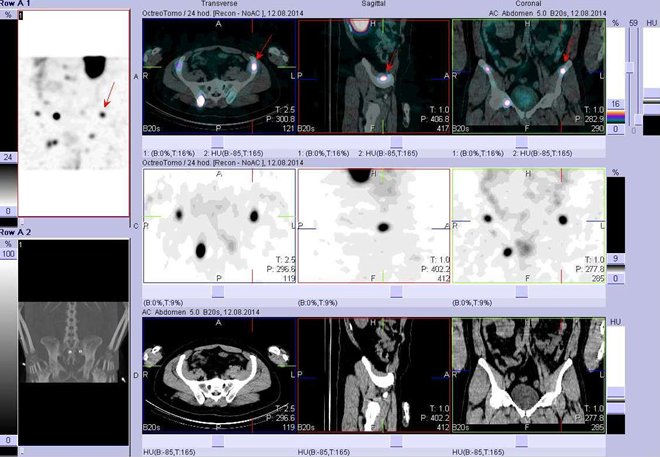 Obr. č. 7: Fúze obrazů SPECT a CT - břicho, pánev. Vyšetření 24 hod. po aplikaci radiofarmaka. Nahoře fúze obrazů, uprostřed SPECT, dole CT. Vždy nad sebou: vlevo transverzální řezy, uprostřed sagitální řezy, vpravo koronární. Zaměřeno na ložisko v pánvi vlevo.