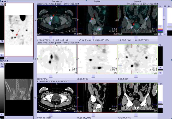 Obr. č. 9: Fúze obrazů SPECT a CT – břicho, pánev. Vyšetření 24 hod. po aplikaci radiofarmaka. Nahoře fúze obrazů, uprostřed SPECT, dole CT. Vždy nad sebou: vlevo transverzální řezy, uprostřed sagitální řezy, vpravo koronární. Zaměřeno na ložisko v pánvi vpravo.