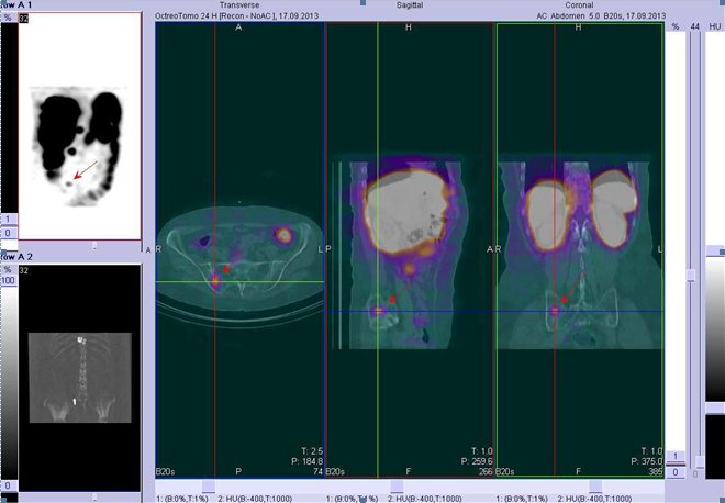 Obr. . 2: Fze obraz SPECT a CT  bicho. Vyeten 24 hod. po aplikaci radioindiktoru. Vlevo transverzln ez, uprosted sagitln ez, vpravo koronrn. Zameno na loisko v lopat prav kosti kyeln.